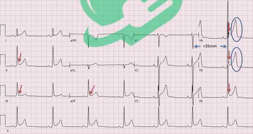 Artificial Intelligence in ECG Analysis