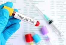 Hypothyroidism Treatments