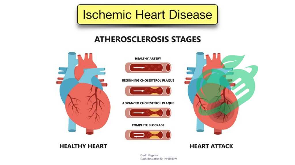 Potential Complications and Long-Term Effects