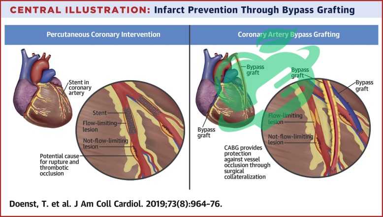 Stem Cell Therapy for CAD