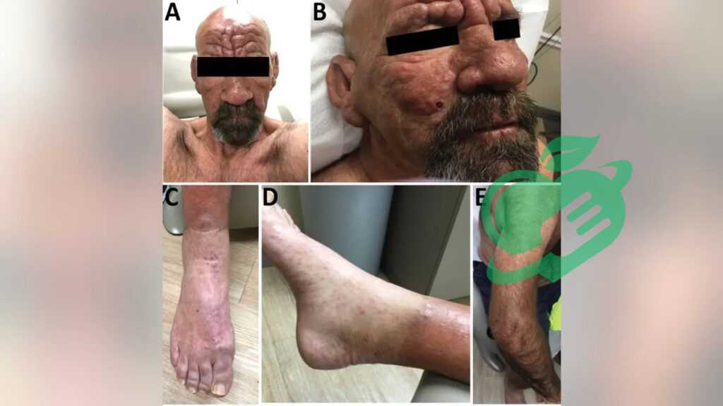 Stigma and Misconceptions Surrounding Leprosy in florida