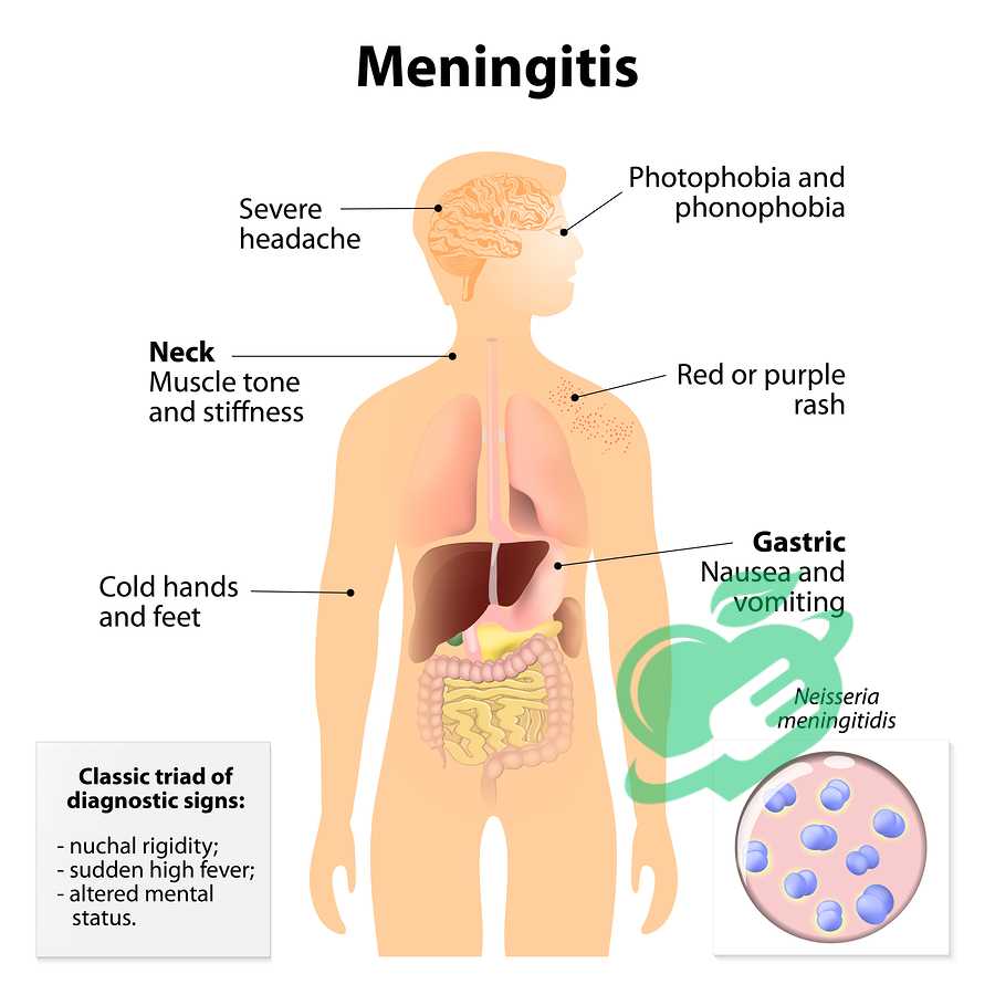 Supportive Care and Hospitalization-meningitis and headache