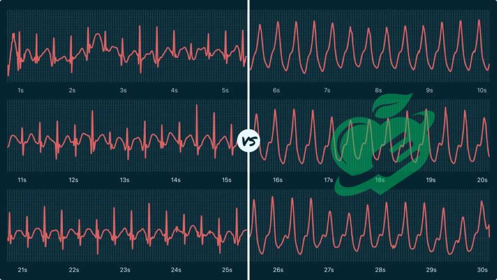 Ventricular Tachycardia