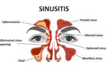 The Ultimate Sinus Surgery Survival Guide: Tips for a Smooth Recovery