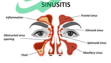 The Ultimate Sinus Surgery Survival Guide: Tips for a Smooth Recovery