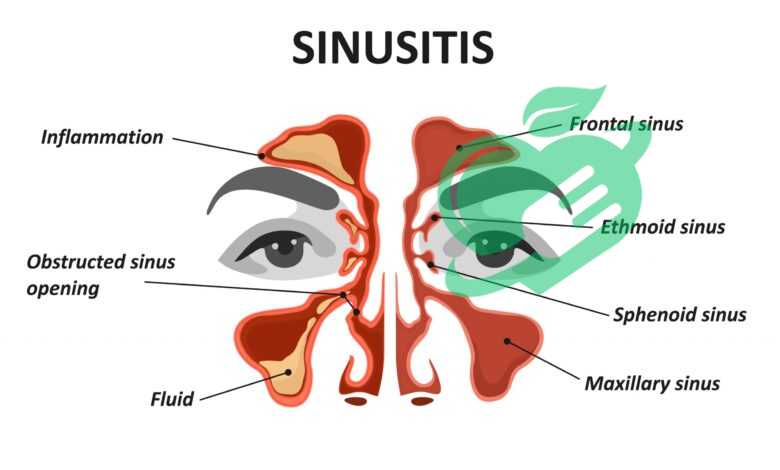 The Ultimate Sinus Surgery Survival Guide: Tips for a Smooth Recovery