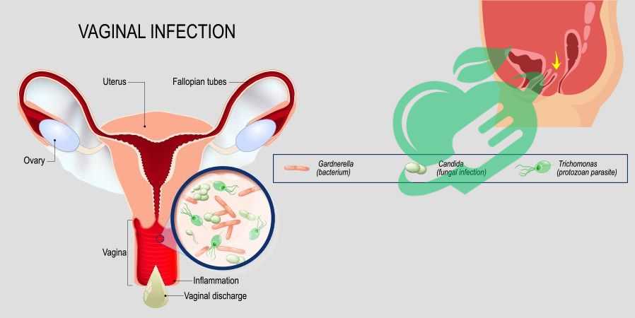 Types of Vaginitis