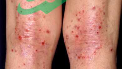 Leg Pimples
