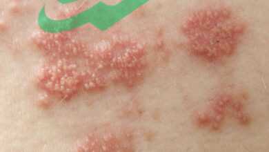 Top 10 Skin Disorders You Need to Know About Right Now