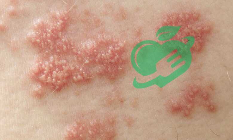 Top 10 Skin Disorders You Need to Know About Right Now