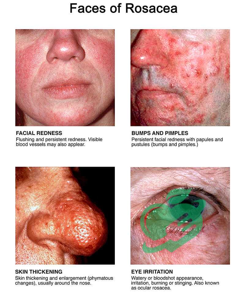 Treatment Approaches-Skin disorder