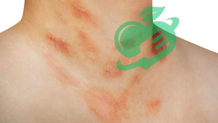 Triggers and Symptoms-Skin disorders