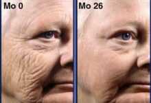 retinol before and after