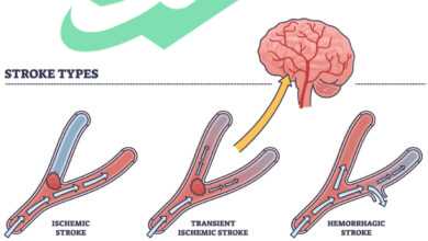 stroke tia attack