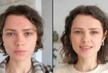 Microneedling Before After Real Results You Must See!