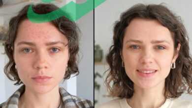 Microneedling Before After Real Results You Must See!