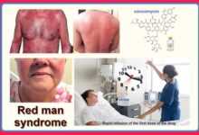 What is Red Man's Syndrome?