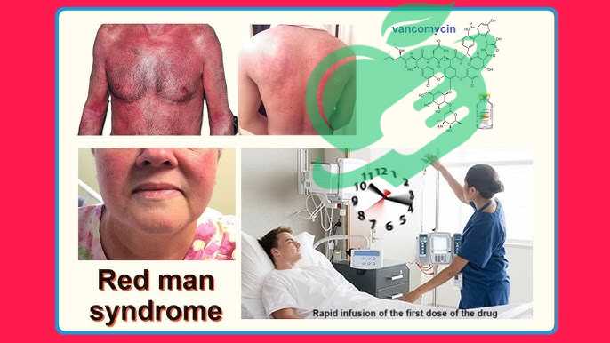 What is Red Man's Syndrome?